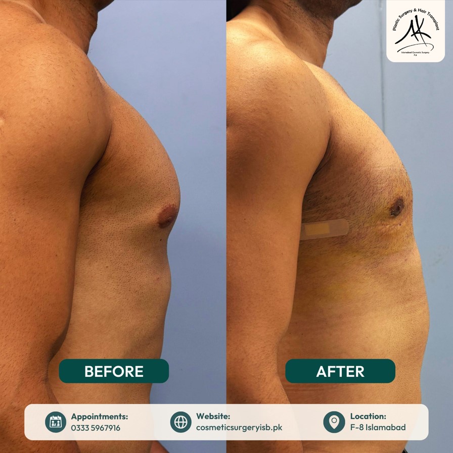 Contact form for liposuction consultation