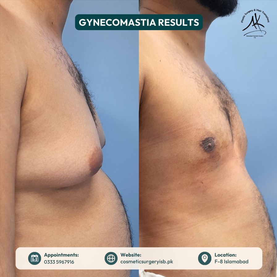 Before and after liposuction results