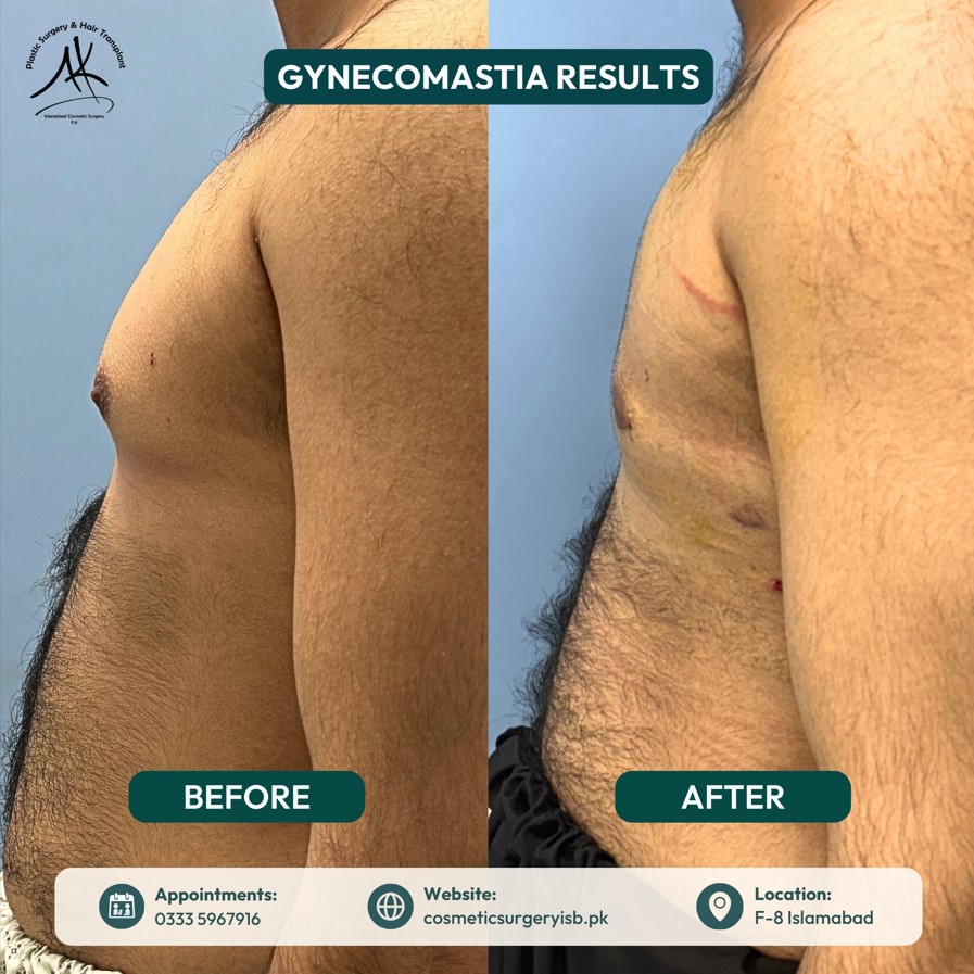 Liposuction clinic in Islamabad
